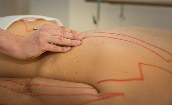 Akupunkt Massage